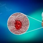 Ülseratif Kolit ve Crohn Farkı Nedir? Ameliyat Ne Zaman Gerekir?